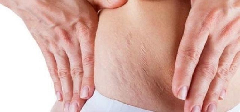 4 Cara Menyamarkan Stretch Mark Secara Alami Setelah Melahirkan