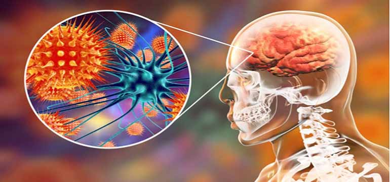 Apa Saja Tanda-tanda dan Aspek Penyebab Penyakit Meningitis?
